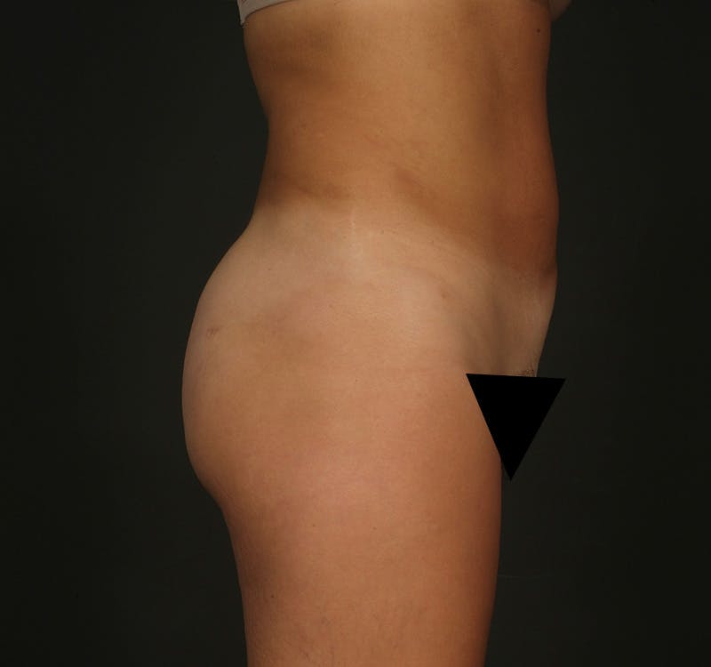 Liposuction Before & After Gallery - Patient 347763 - Image 6