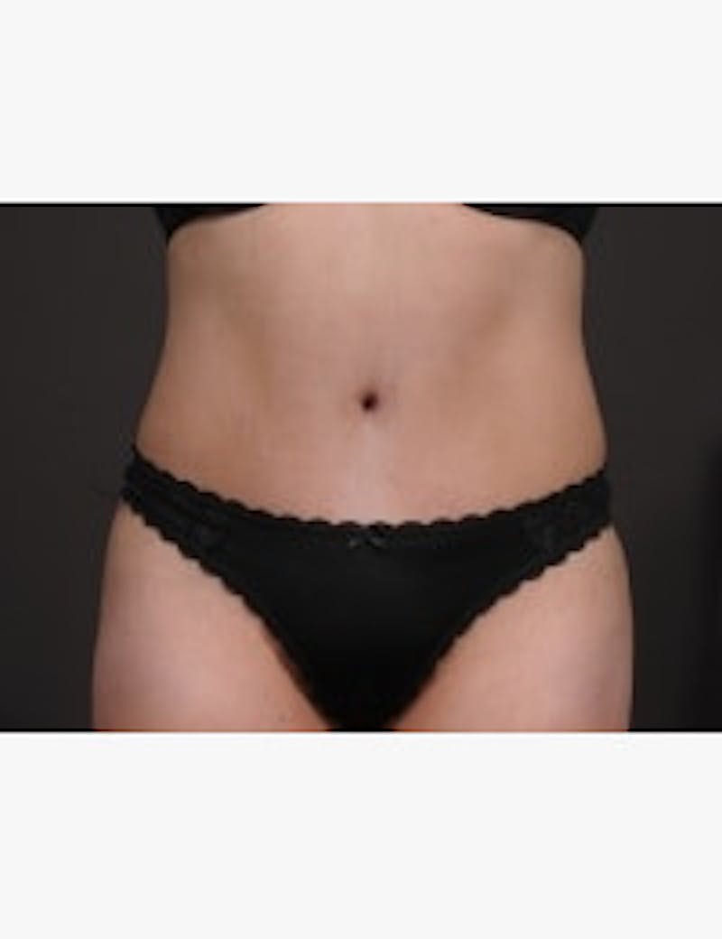 Liposuction Before & After Gallery - Patient 199452 - Image 2