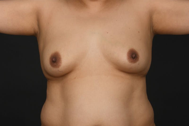 Breast Augmentation Before & After Gallery - Patient 359756 - Image 1