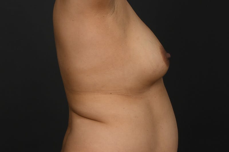 Breast Augmentation Before & After Gallery - Patient 359756 - Image 3
