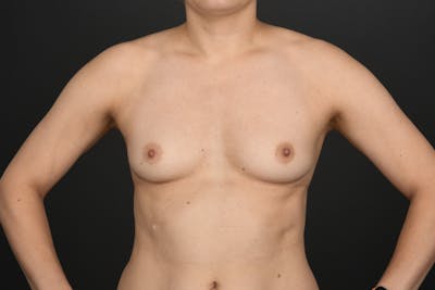 Breast Augmentation Before & After Gallery - Patient 281711 - Image 1