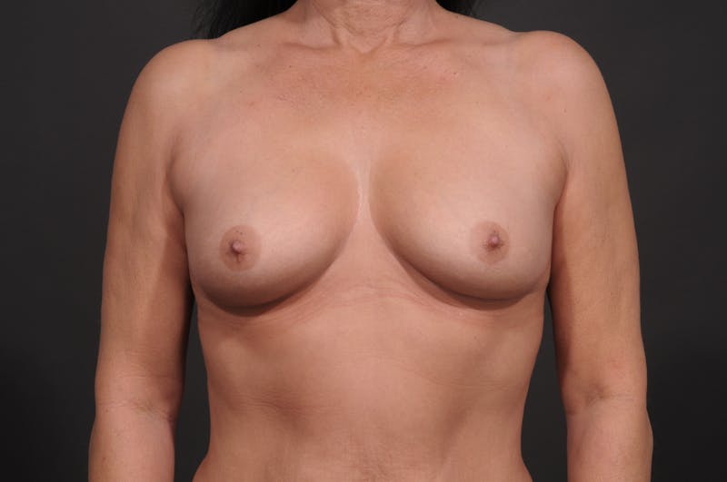 Breast Augmentation Before & After Gallery - Patient 433366 - Image 1
