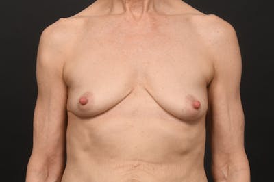 Breast Augmentation Before & After Gallery - Patient 404224 - Image 1
