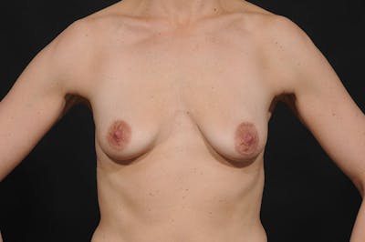 Breast Augmentation Before & After Gallery - Patient 202133 - Image 1