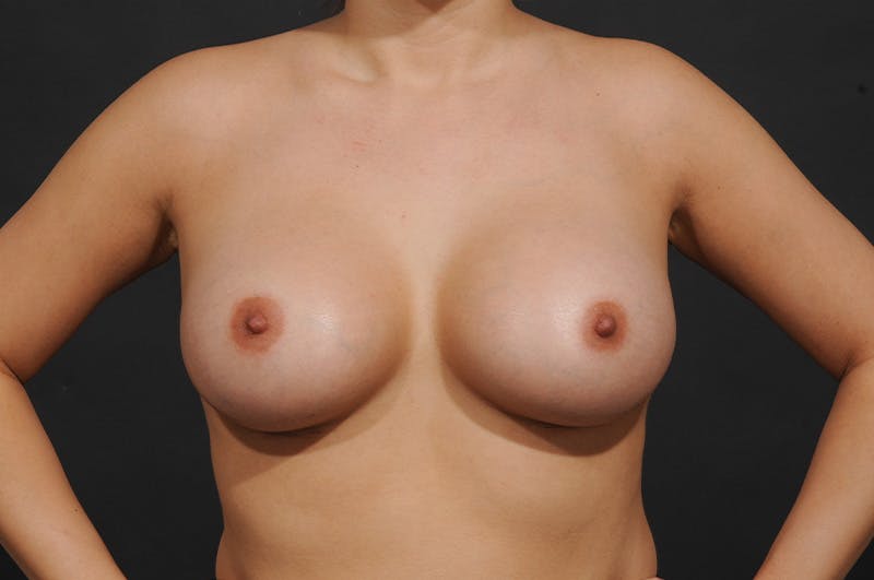 Breast Augmentation Before & After Gallery - Patient 480088 - Image 2