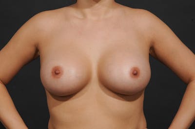 Breast Augmentation Before & After Gallery - Patient 480088 - Image 2