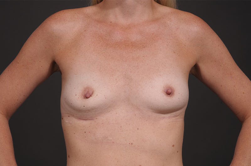 Breast Augmentation Before & After Gallery - Patient 674232 - Image 1
