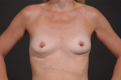 Breast Augmentation Before & After Gallery - Patient 674232 - Image 1