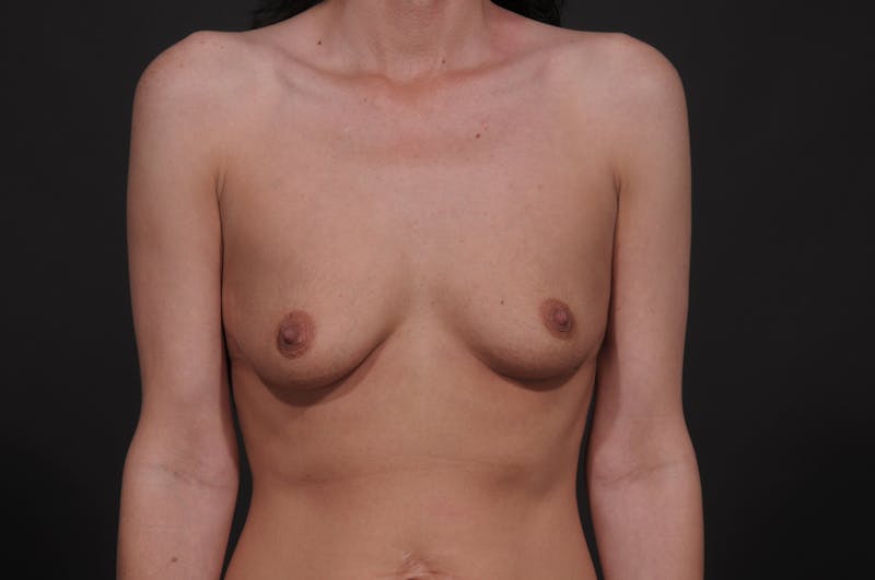 Breast Augmentation Before & After Gallery - Patient 354250 - Image 1