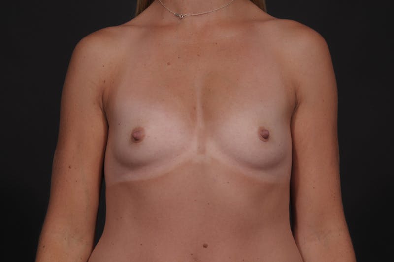 Breast Augmentation Before & After Gallery - Patient 192213 - Image 1