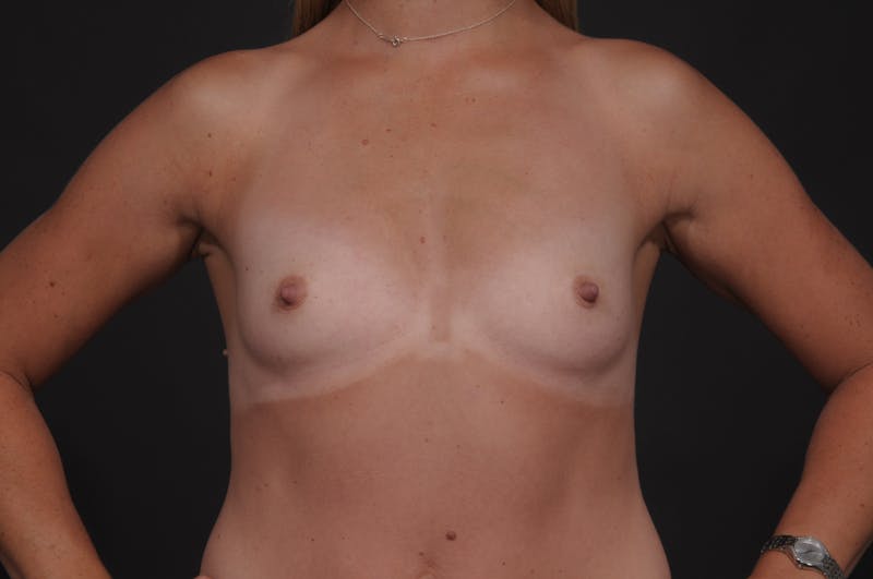 Breast Augmentation Before & After Gallery - Patient 192213 - Image 3