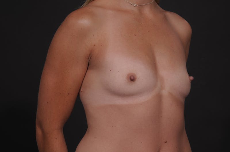 Breast Augmentation Before & After Gallery - Patient 192213 - Image 5