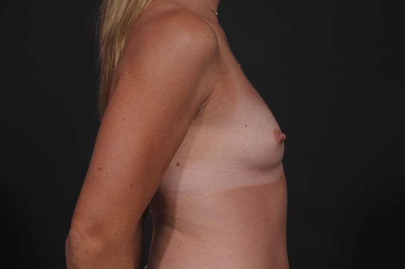 Breast Augmentation Before & After Gallery - Patient 192213 - Image 7
