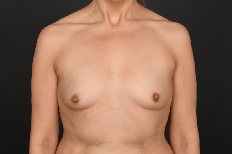 Breast Augmentation Before & After Gallery - Patient 293725 - Image 1
