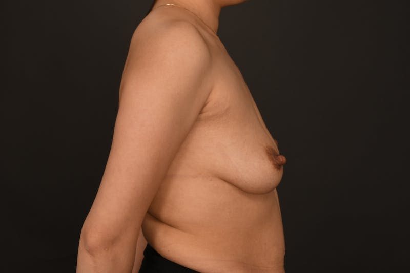 Breast Augmentation Before & After Gallery - Patient 417340 - Image 7