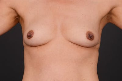 Breast Augmentation Before & After Gallery - Patient 371611 - Image 1