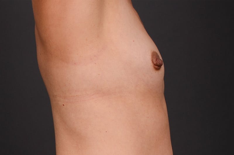Breast Augmentation Before & After Gallery - Patient 371611 - Image 5