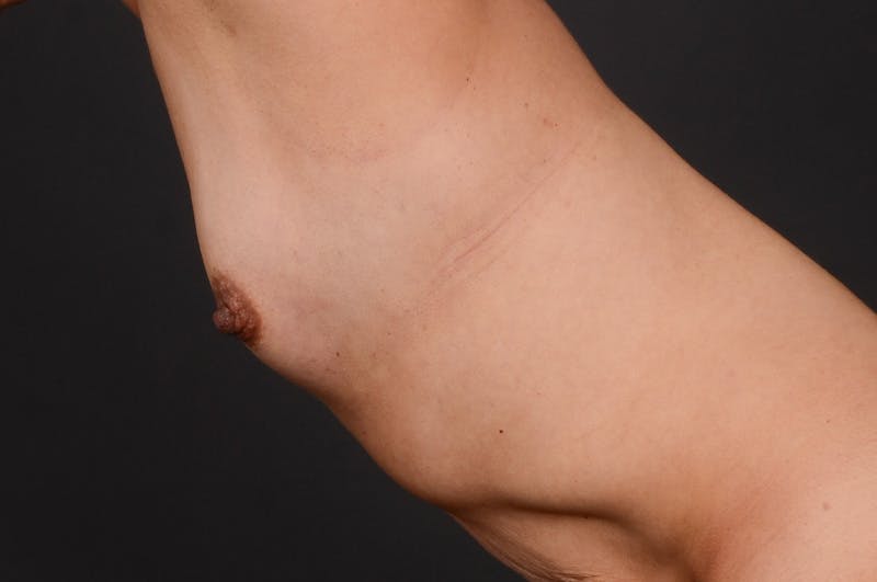 Breast Augmentation Before & After Gallery - Patient 371611 - Image 9