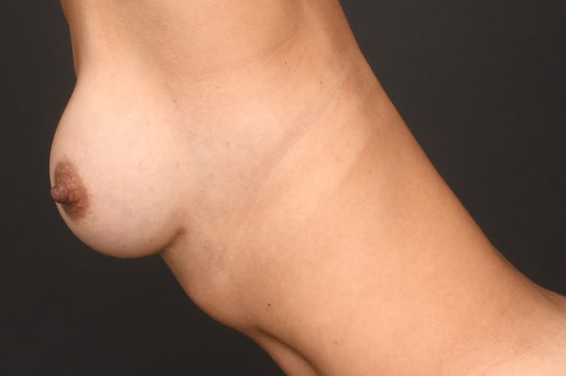 Breast Augmentation Before & After Gallery - Patient 371611 - Image 10