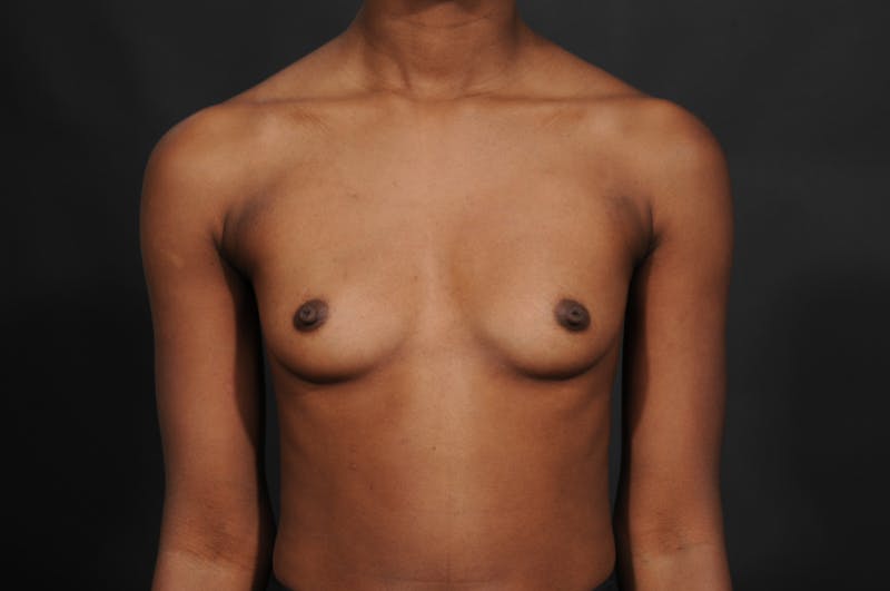 Breast Augmentation Before & After Gallery - Patient 252386 - Image 1