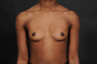 Breast Augmentation Before & After Gallery - Patient 252386 - Image 1