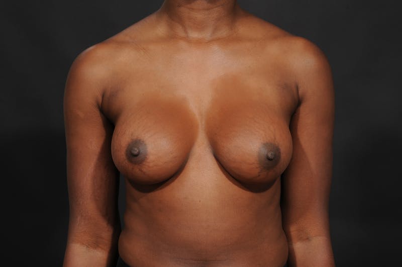 Breast Augmentation Before & After Gallery - Patient 252386 - Image 2