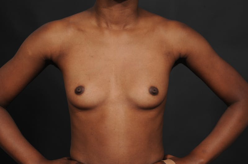 Breast Augmentation Before & After Gallery - Patient 252386 - Image 3