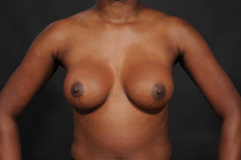 Breast Augmentation Before & After Gallery - Patient 252386 - Image 4