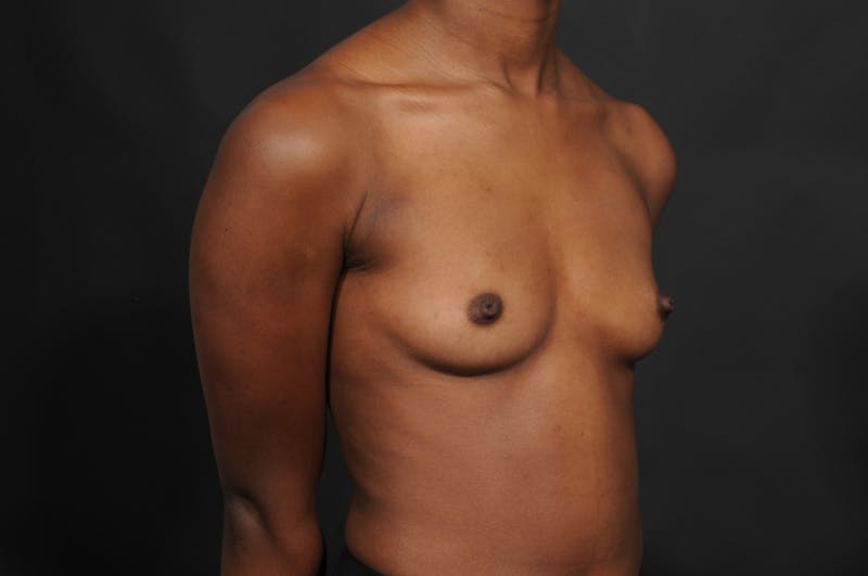 Breast Augmentation Before & After Gallery - Patient 252386 - Image 5