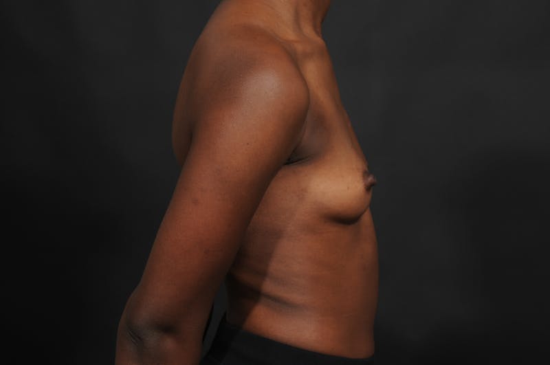Breast Augmentation Before & After Gallery - Patient 252386 - Image 7