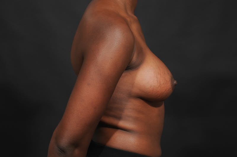 Breast Augmentation Before & After Gallery - Patient 252386 - Image 8