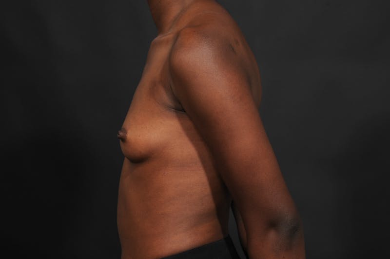 Breast Augmentation Before & After Gallery - Patient 252386 - Image 9