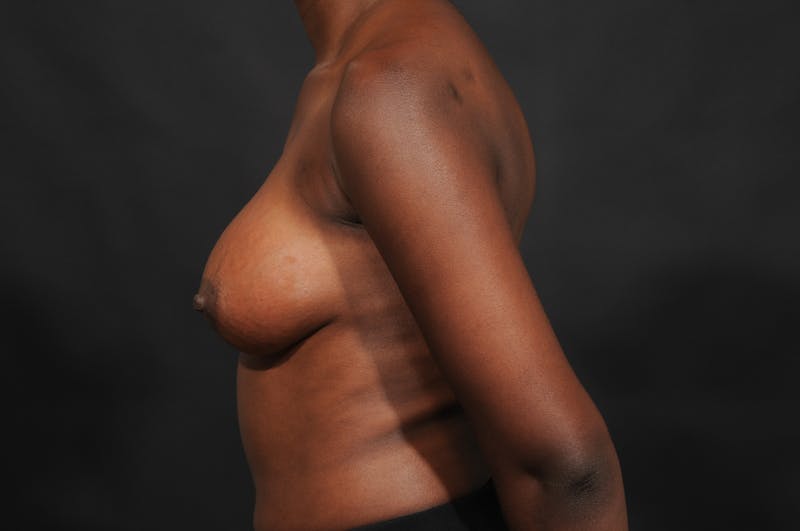 Breast Augmentation Before & After Gallery - Patient 252386 - Image 10