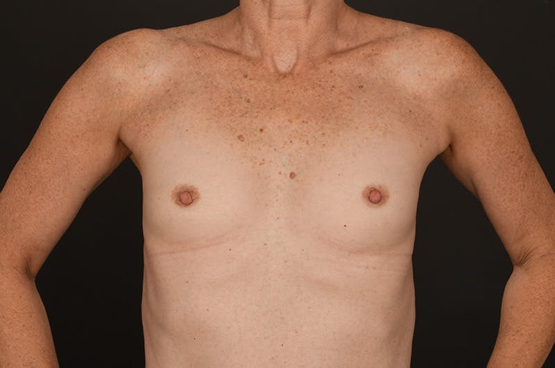 Breast Augmentation Before & After Gallery - Patient 227264 - Image 1