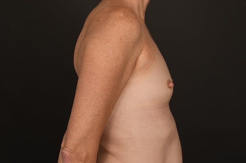 Breast Augmentation Before & After Gallery - Patient 227264 - Image 5