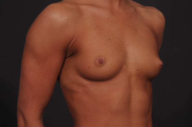 Breast Augmentation Before & After Gallery - Patient 249484 - Image 3