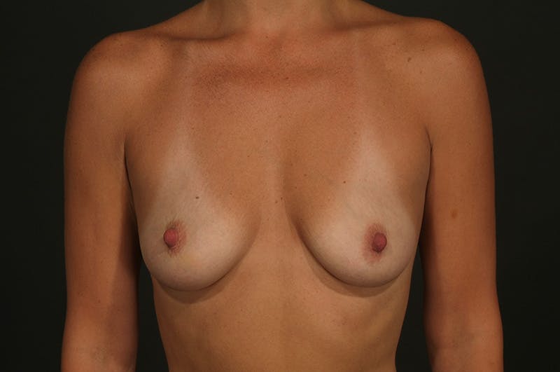 Breast Augmentation Before & After Gallery - Patient 242449 - Image 1