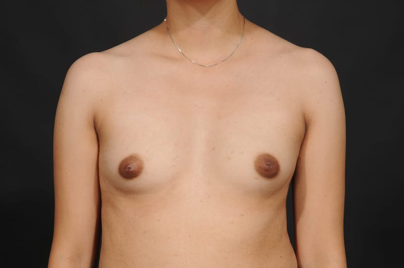 Breast Augmentation Before & After Gallery - Patient 297593 - Image 1