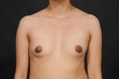 Breast Augmentation Before & After Gallery - Patient 297593 - Image 1