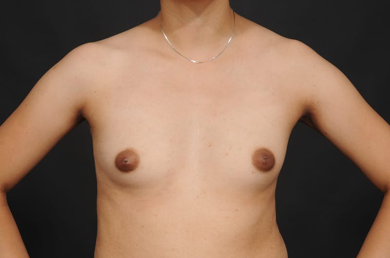 Breast Augmentation Before & After Gallery - Patient 297593 - Image 3