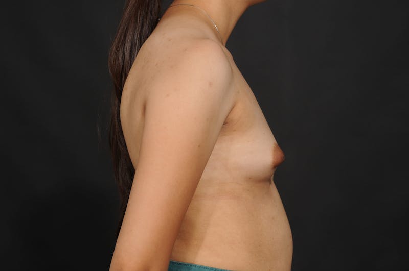 Breast Augmentation Before & After Gallery - Patient 297593 - Image 11