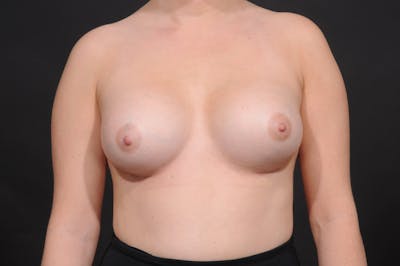 Breast Augmentation Before & After Gallery - Patient 337115 - Image 2