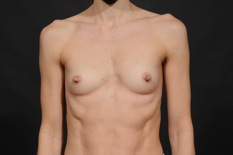 Breast Augmentation Before & After Gallery - Patient 380689 - Image 1