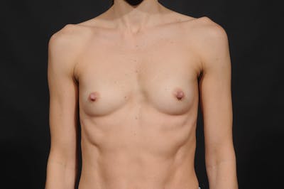 Breast Augmentation Before & After Gallery - Patient 380689 - Image 1