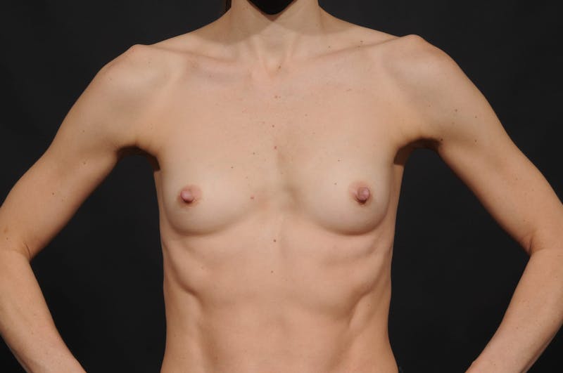 Breast Augmentation Before & After Gallery - Patient 380689 - Image 3