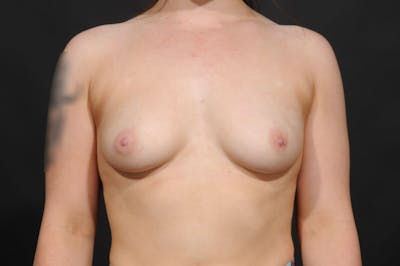 Breast Augmentation Before & After Gallery - Patient 253953 - Image 1