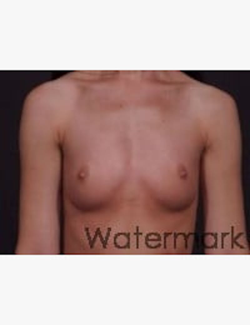 Breast Augmentation Before & After Gallery - Patient 248356 - Image 1