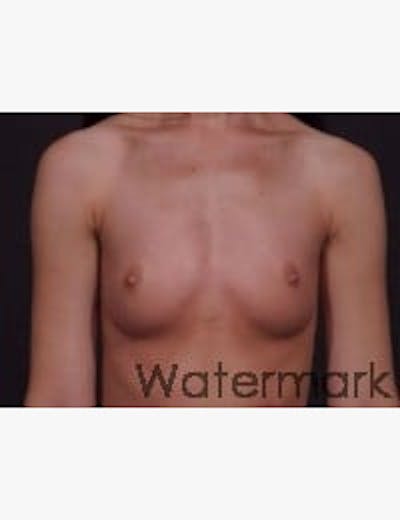 Breast Augmentation Before & After Gallery - Patient 248356 - Image 1