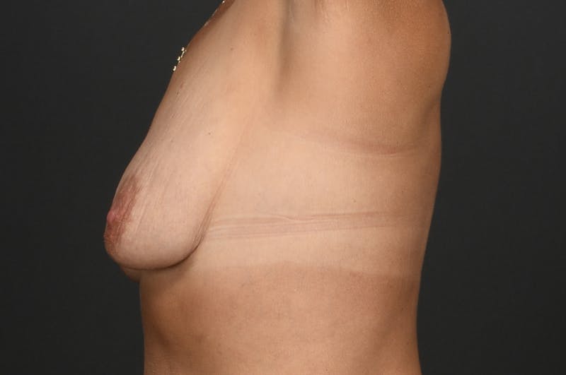 Breast Lift Before & After Gallery - Patient 140482 - Image 5