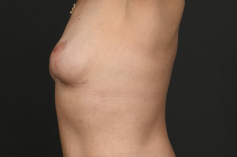 Breast Lift Before & After Gallery - Patient 140482 - Image 6